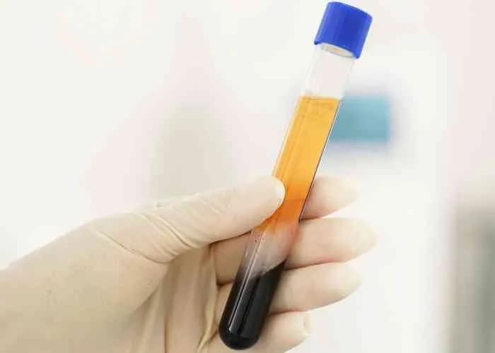 A gloved clinician holding a separated blood sample tube, plasma layered above cells